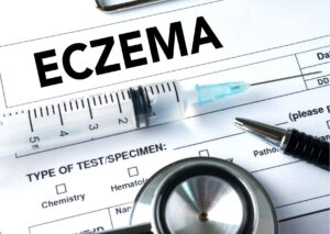 Eczema Treatment for Improved Skin Health