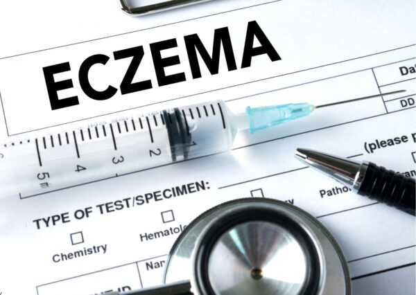 Eczema Treatment for Improved Skin Health